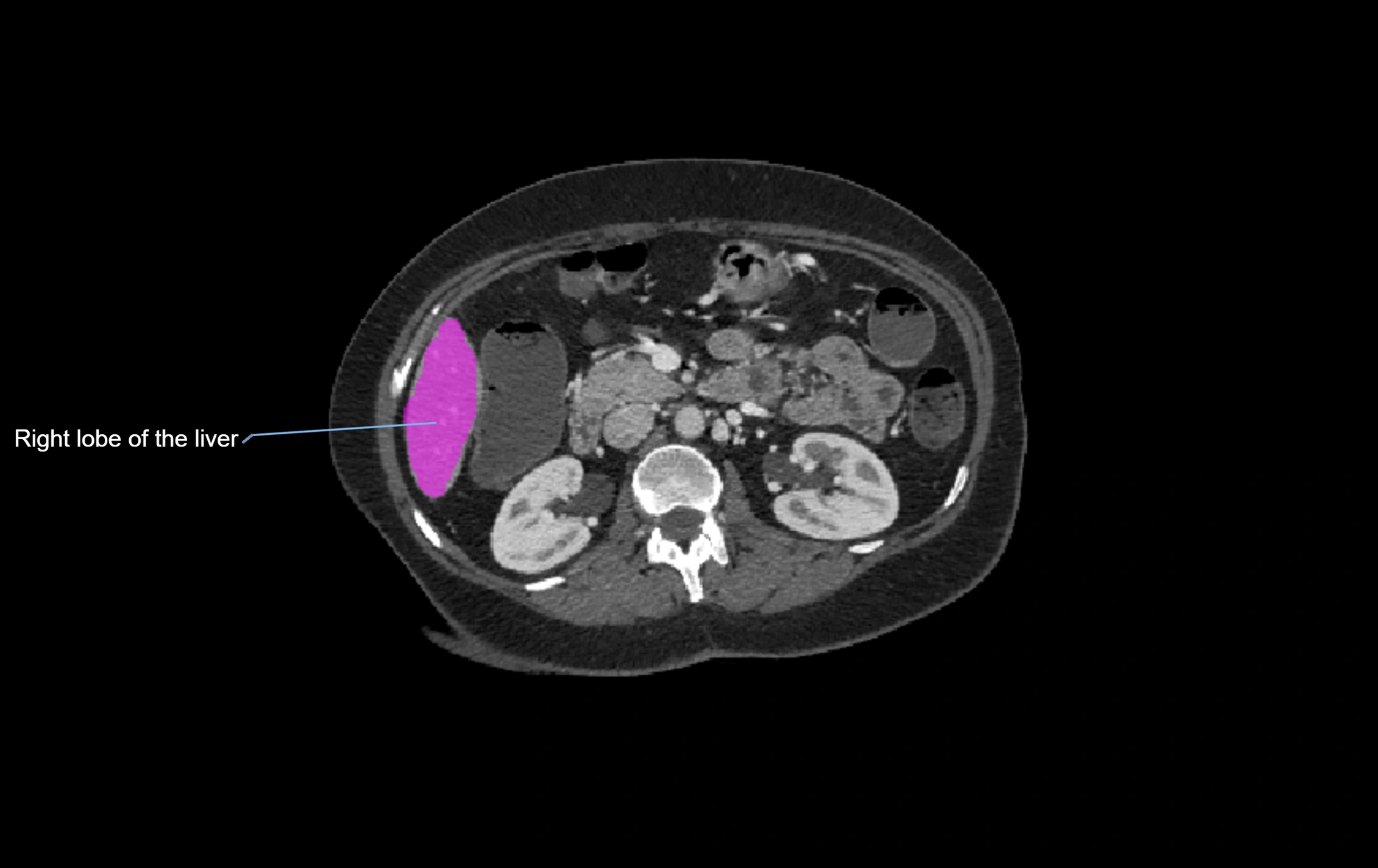 CT lliver lobes axial cross sectional anatomy labelled image -00019.webp